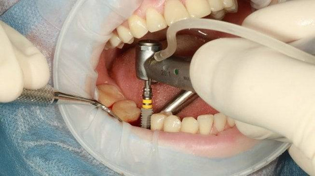 Ilustrasi operasi cabut gigi. Foto: Pixabay