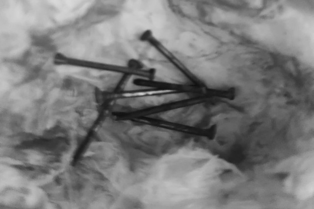 Penampakan paku hingga jarum yang keluar dari tubuh Soeparwati, Istri Dosen Fakultas Ilmu Tarbiyah dan Keguruan UIN Sunan Kalijaga Yogyakarta Dr Zainal Arifin Ahmad yang kena sihir. Foto: Dok Dr Zainal Arifin Ahmad