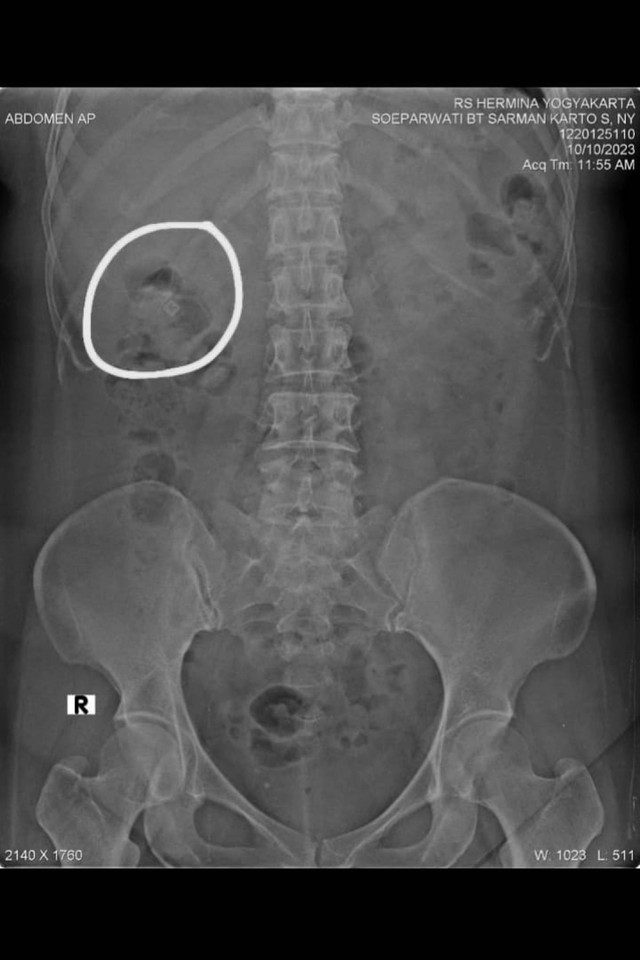 Hasil rontgen tubuh Soeparwati, Istri Dosen Fakultas Ilmu Tarbiyah dan Keguruan UIN Sunan Kalijaga Yogyakarta Dr Zainal Arifin Ahmad yang kena sihir. Foto: Dok Dr Zainal Arifin Ahmad