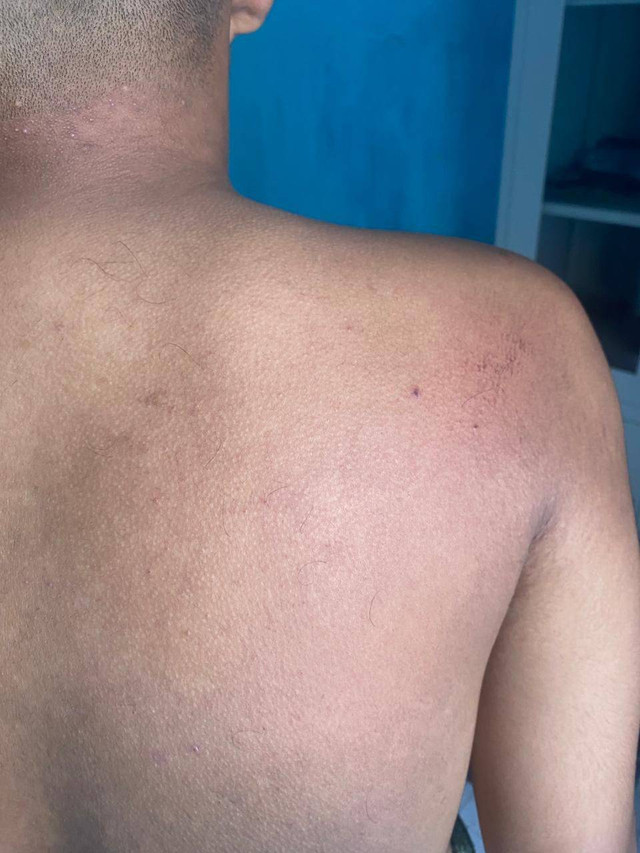 Tubuh P yang memar. Dok: kumparan