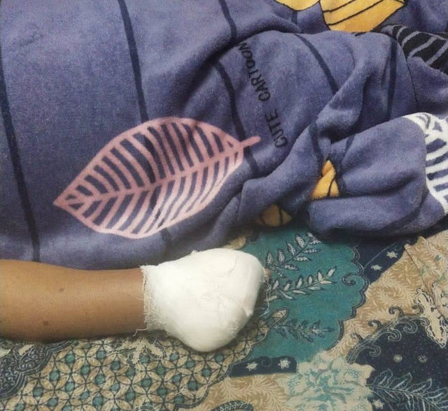 4 jari tangan nenek di Karawang diamputasi usai cedera saat ikut lomba tarik tambang. Dok: Istimewa