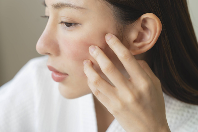 Ilustrasi eksim. Foto: Pormezz/Shutterstock 