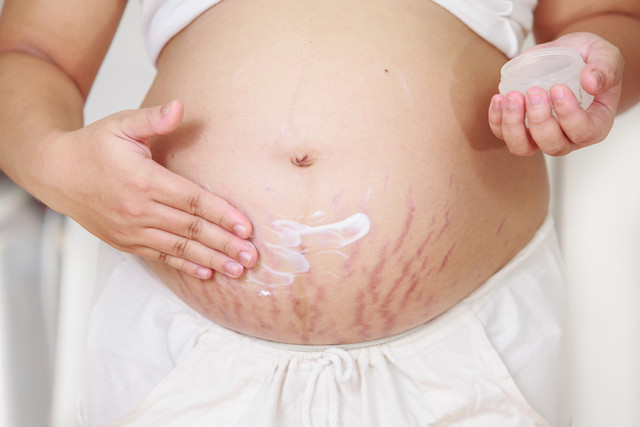 Stretch mark saat hamil. Foto: baipooh/Shutterstock