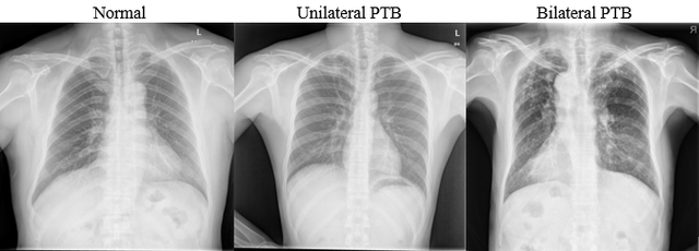 Perbandingan X-ray paru: Normal, Unilateral PTB, dan Bilateral PTB.