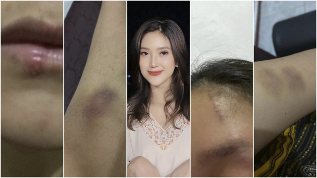 Foto-foto lebam Adelia Septa. Foto: Instagram/ @adeliasepta