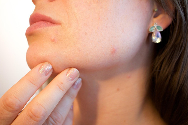 Ilustrasi rekomendasi micellar water untuk kulit berjerawat dan bruntusan. Sumber : Pixabay/Pexels