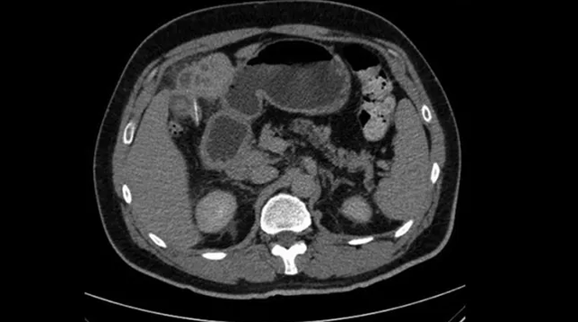 Pemindaian CT pada perut pasien ini menunjukkan adanya benda asing di lobus kiri hati. Benda asing tersebut berupa garis putih kecil di sisi kiri atas gambar.  Foto: BMJ Case Reports