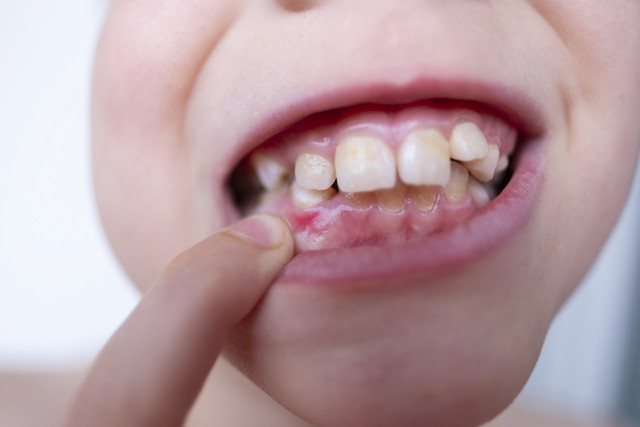 Ilustrasi Gigi Anak Tonggos. Foto: Shutterstock