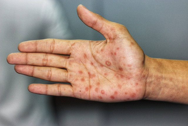 Ilustrasi ciri-ciri sifilis pada pria. Foto: Shutterstock