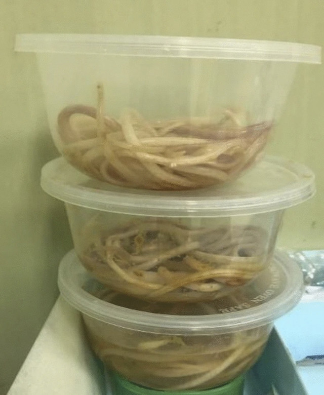 Cacing yang berada di usus anak berusia 3 tahun asal Jember. Foto: Dok. Journal of Medical Case Reports