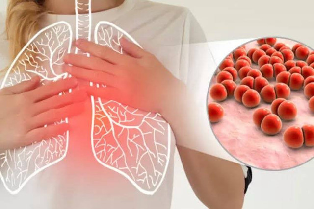 Ilustrasi pneumonia bilateral adalah. Foto: pixabay