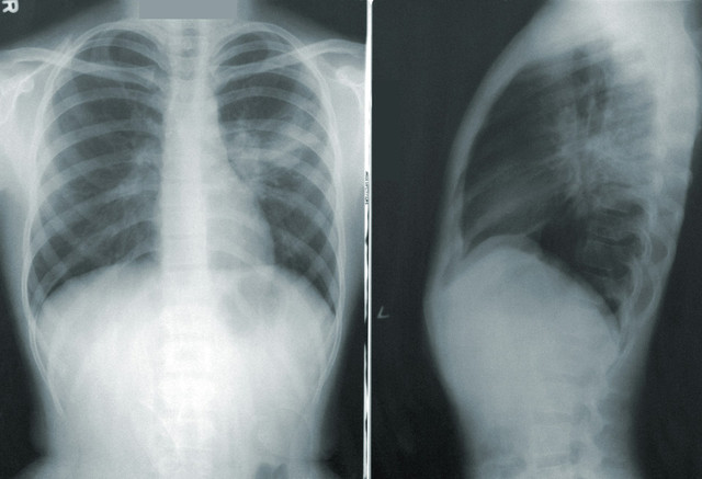 Ilustrasi rontgen paru-paru penderita pneumonia ganda. Foto: Unsplash