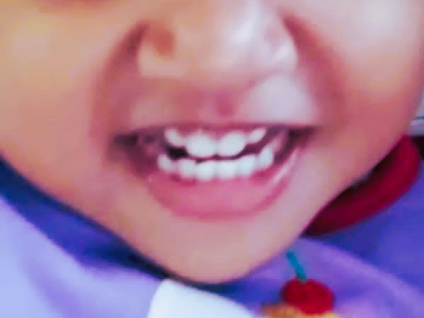 Gigi susu anak (Source: Dokumentasi Pribadi)