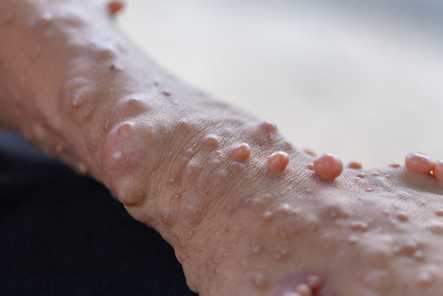 Ilustrasi neurofibromatosis. Foto: Sinhyu Photographer/Shutterstock