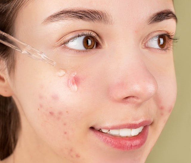 Ilustrasi skincare emina untuk menghilangkan bekas jerawat dan bruntusan. Sumber: www.pexels.com