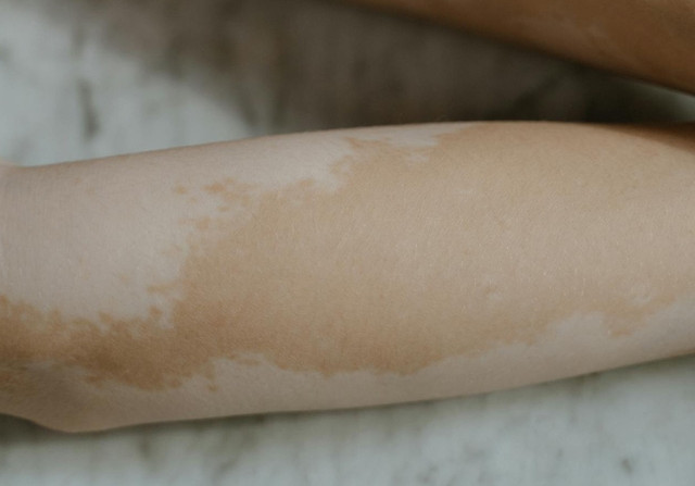 Ilustrasi ciri-ciri autoimun kulit. Foto: Pexels.com