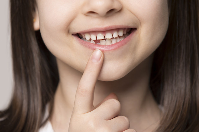 Ilustrasi gigi susu anak renggang. Foto: Shutterstock