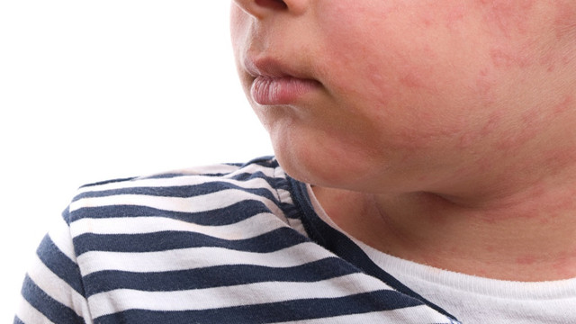 Ilustrasi biduran pada anak. Foto: Shutterstock