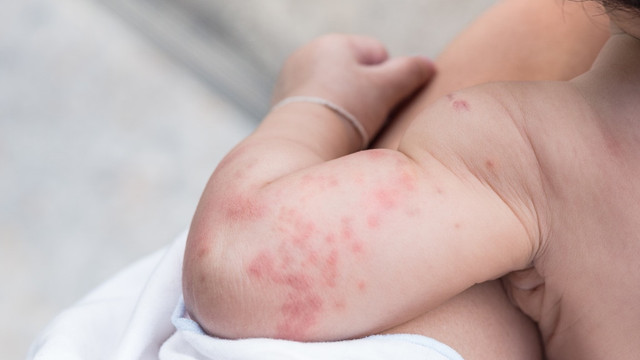 Ilustrasi biduran pada anak. Foto: Shutterstock