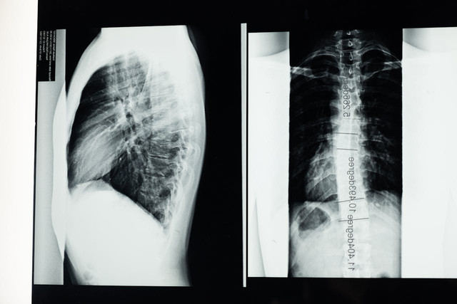 Ilustrasi skoliosis. Foto: Pexels.com