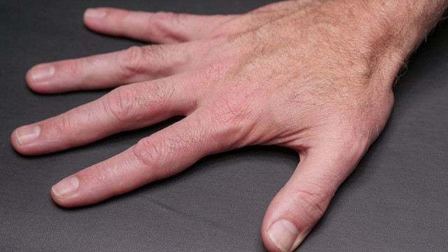 Ilustrasi kutu air di tangan. Foto: Pexels.com