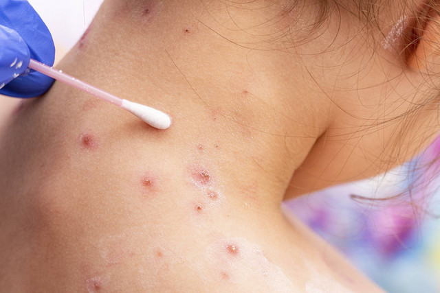 Ilustrasi cara mengobati cacar air agar cepat kering dan hilang. Foto: Shutterstock