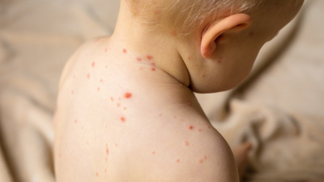  Ilustrasi cacar air. Foto: Shutterstock