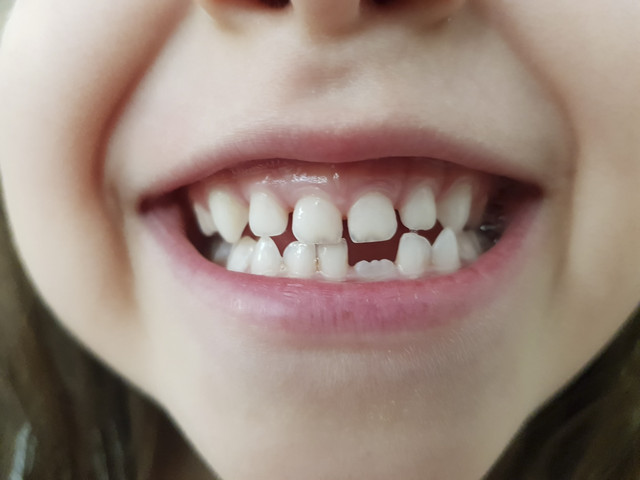 Ilustrasi bercak putih pada gigi anak. Foto: Pangram/Shutterstock