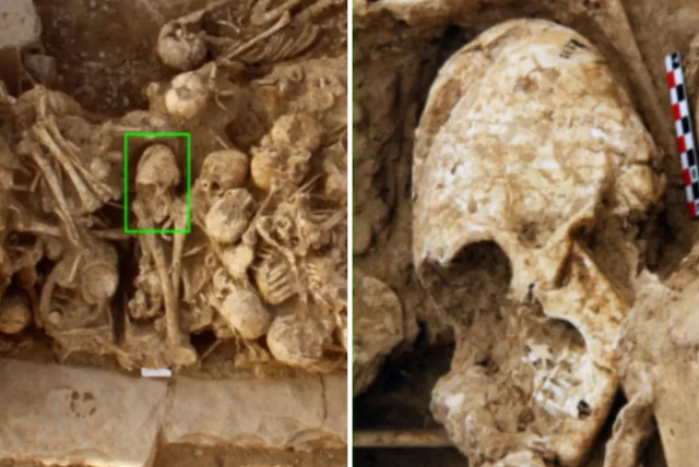 Tengkorak gadis berbentuk kerucut. Foto: International Journal of Osteoarcheology/Mahdi Alirezazadeh/ Hamed Vahdati Nasab