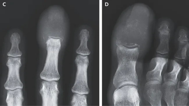 Pemindaian ini menunjukkan bagaimana kanker telah menyebabkan tulang-tulang di jari tangan dan kaki. Foto: The New England Journal of Medicine