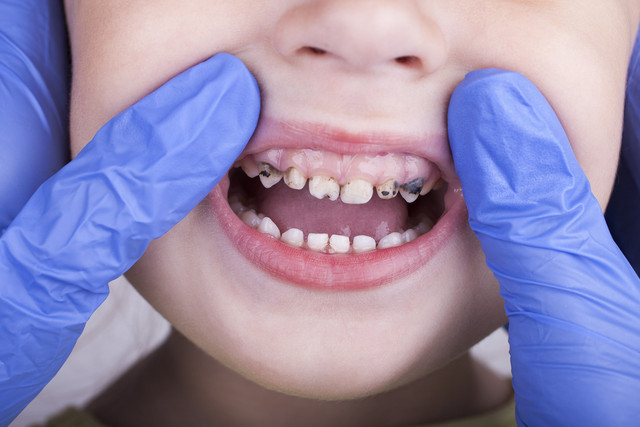 Ilustrasi karies gigi pada anak. Foto: Stanislaw Mikulski/Shutterstock