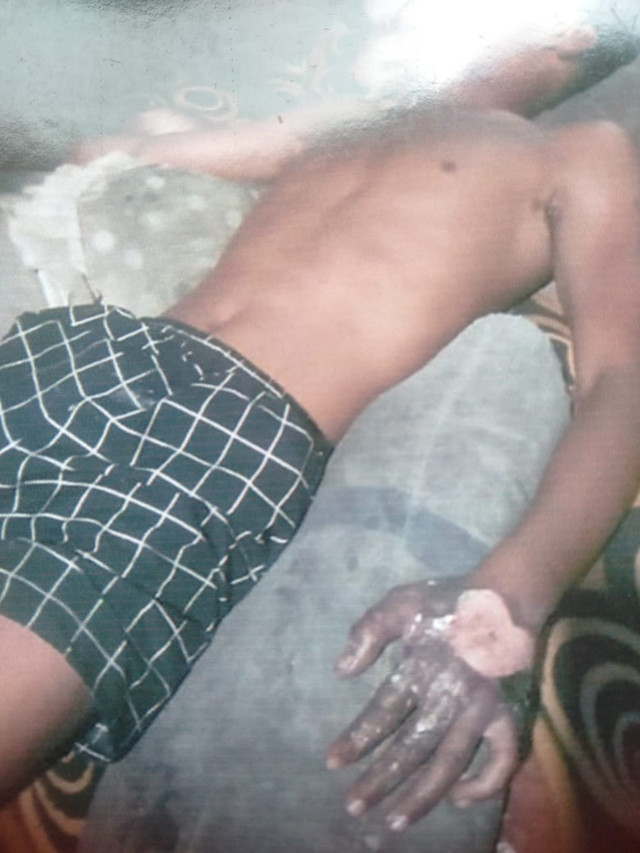 Pria di Deli Serdang diduga dibakar oleh ASN lantaran mencuri ubi. Foto: Dok. Istimewa