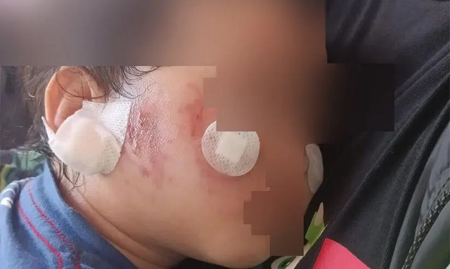 Balita malang yang mengalami luka-luka usai dititipkan di daycare Surabaya. Foto: Istimewa 