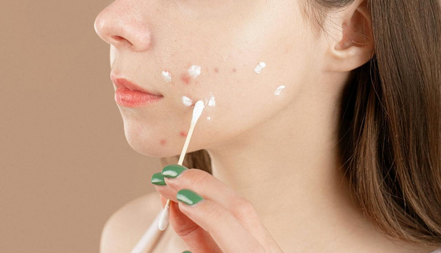 Ilustrasi skincare untuk menghilangkan bekas jerawat. Foto: Pexels