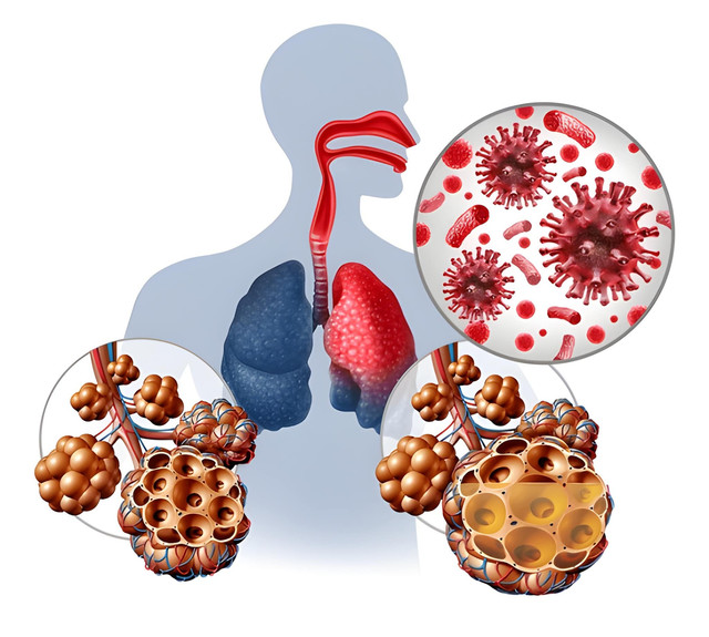 Acute Respiratory Disease or ARD affecting different parts of the respiratory tract and nose throat airways and lungs infected by a viral bacterial or fungal infection with 3D illustration elements. Sumber:Shutterstock/Lightspring