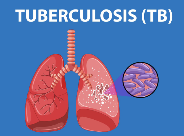 Tuberkulosis di Indonesia: Kondisi Terkini, Tantangan dan Pemanfaatan Teknologi