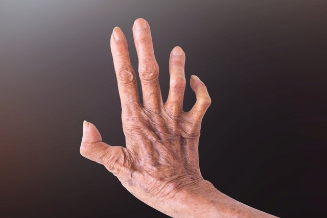 Ilustrasi Kusta. Foto: ADN Captures/Shutterstock