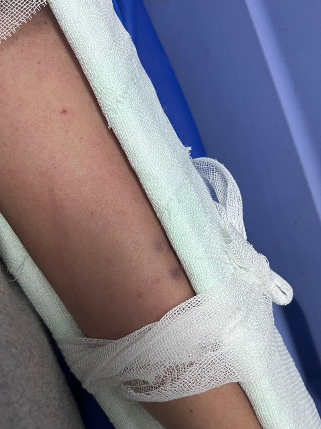 Bekas gigitan kobra. dok Pribadi