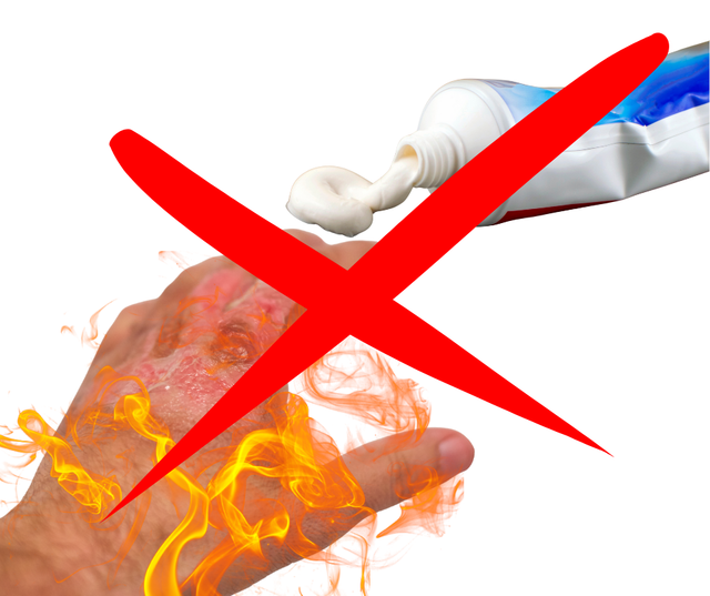 Jangan oleskan odol pada luka bakar. Foto: Dokumentasi pribadi