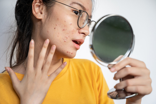 5 Kandungan Skincare yang Harus Dihindari Pemilik Kulit Berjerawat. Foto: Boyloso/Shuttersock