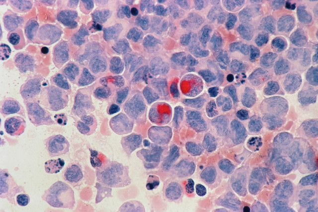ilustrasi Vidi aldiano sakit kanker apa. Unsplash/National Cancer Institute