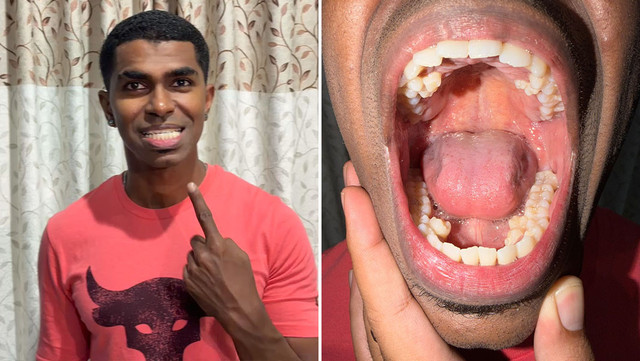 Prathab Muniandy, pria dengan gigi terbanyak di dunia. Foto: Guinness World Records