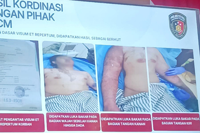 Kondisi Andrie Yunus setelah penyiraman air keras pada Kamis lalu yang ditampilkan oleh pihak kepolisian di Polda Metro Jaya, Senin (16/3). Foto: Ryan Iqbal/kumparan