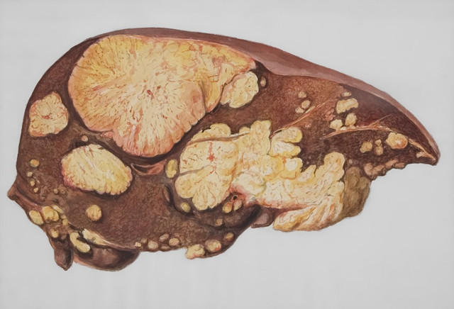 Ilustrasi penyakit hepatitis B. Foto: Unsplash