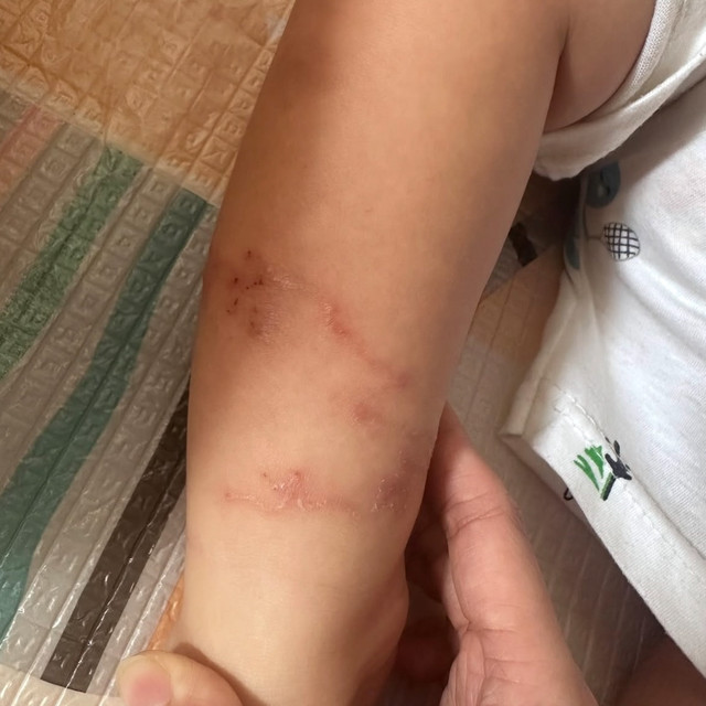 Anak kemasukan cacing di kakinya. Foto: Dok. Istimewa