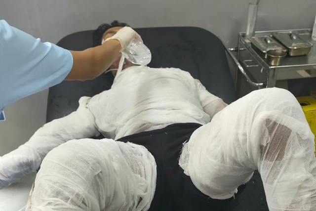 Kondisi korban kasus pembakaran sopir truk galian. Foto: Dok. Satreskrim Polres Karangasem