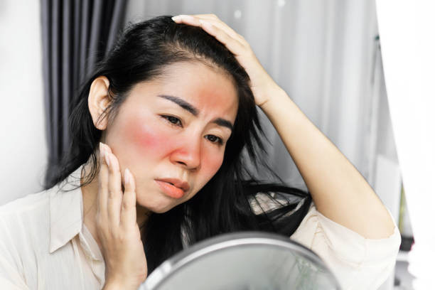 Cara Mengatasi Kulit Terbakar Matahari. Foto: Pixabay