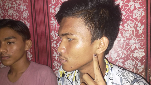 CHANDRA (19), remaja penyandang tunanetra (buta) memperlihatkan bekas ditinju anggota Polres Kampar, Sabtu malam (26/2/2022), di Jalan Ahmad Yani, Bangkinang, Kampar, Riau. 