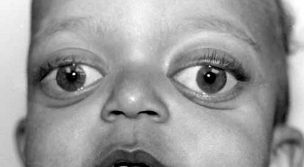 Wajah anak sindrom Char. Foto: Dok. MedlinePlus