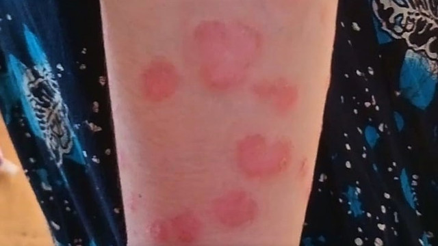 Kondisi kulit melepuh yang dialami seorang guru SD di Kabupaten Limapuluh Kota, Sumatera Barat. Foto: istimewa